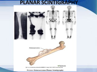 PLANAR SCINTIGRAPHY
 