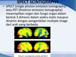 SPECT SCINTIGRAPHY
• SPECT (single photon emission tomography)
atau PET (Positron emission tomography)
meanmpilkan organ dan fungsi organ dalam
bentuk 3 dimensi dalam waktu statis maupun
dinamis dengan pengambilan multiple image
dari arah yang berbeda.
 