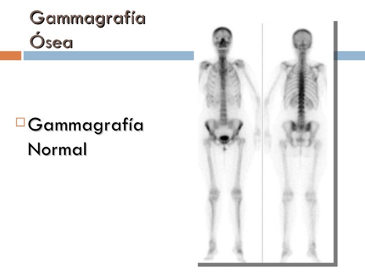 Gammagrafia Ósea