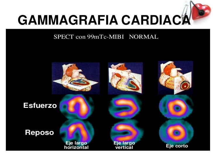 Gamagrama Cardiaco Pdf