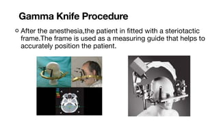 GAMMA KNIFE.pdf