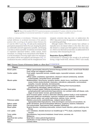 scribed as voluntary or involuntary. Voluntary movements
include deliberate or accidental movement of the patient’s
position often occurring as the patient relaxes between the
CT and the SPECT scan (Fig. 10) and can be minimized by
good patient preparation before the scan, keeping the patient
as comfortable and well supported as possible, and keeping
scan times as short as possible. Involuntary movements relate
to respiration (discussed further), cardiac motion, bowel
movement, or a change in size and position of the bladder. It
is at the boundaries of moving organs where the misregistra-
tion artifacts will be most apparent and disruptive (Fig. 11).
Localization becomes confused and the misapplication of at-
tenuation correction data may over- or undercorrect the
SPECT data and so mimic the appearance of uptake defects or
an underlying pathology.
Although modern SPECT/CT systems have software to
manually move one dataset relative to the other, this is usu-
ally limited to a simple pixel shift applied to the entire data-
set, which is not ideal and can introduce an additional level of
uncertainty when interpreting the scan.
Respiration During SPECT/CT
Conventional CT scanning is fast enough to be performed
during a single breath-hold, whereas a SPECT scan usually
Figure 16 Many of the installed SPECT/CT systems incorporate a nonstandard CT scanner, which do not have the same
imaging capability of conventional stand-alone CT scanners. (Color version of ﬁgure is available online.)
Table 5 Common Causes of Extraosseus Uptake on a Bone Scan3,7,31-33,36,37,56-106
Organs Conditions
Breast uptake Diffuse: gynecomastia induced by hormonal therapy (prostate cancer), normal breast (females)
Focal: benign and malignant conditions
Cardiac uptake Focal uptake: myocardial necrosis, unstable angina, myocardial contusion, ventricular
aneurysm
Diffuse uptake: amyloidosis, hypercalemia, adriamycin induced cardiotoxicity, alcoholic
cardiomyopathy, pericardial tumors, pericarditis
Muscle uptake Rhabdomyolysis: injury/trauma, excessive exertion, electric burns, renal failure, non-traumatic
causes include cocaine/alcoholic intoxication, scleroderma, polymyositis, carcinomatosis
myopathy, muscular dystrophy, dermatomyositis
Heterotopic bone formation/myositis ossiﬁcans: Following direct trauma/paralysis,
complicated hip arthroplasty, patients with burns
Renal uptake Diffuse increased uptake: Following chemotherapy (vincristine, doxorubicin
cyclophosphamide) nephrocalcinosis/hypercalcemia, iron overload, sickle cell disease, early
stages of acute tubular necrosis, glomerulonephritis
Focal increased uptake: normal or obstructed collecting systems (rarely in renal neoplasms)
Decreased uptake/non-visualization: superscan (malignant and metabolic), nephrectomy
Focal reduced uptake: cyst, partial nephrectomy, abscess, tumor, scarring
Pulmonary uptake Radiation pneumonitis, postradiotherapy, malignant pleural effusion,
hyperparathyroidism/hypocalcemia, rarely bronchogenic carcinoma and sarcoidosis, etc
Splenic uptake Sickle cell disease, glucose-6-phosphtase deﬁciency, lymphoma, leukemia, thalassemia
Gastric uptake Free pertechnetate, hypercalcemia (with metastatic calciﬁcation)
Bowel uptake Surgical diversion, necrotising enterocolitis, ischemic bowel infarction, patient practicing urine
therapy
Liver uptake Liver metastases, elevated aluminum ion breakthrough in 99mTc eluate, amyloidosis, hepatic
necrosis
Tumor uptake Neuroblastoma, lung tumors/metastases, breast tumors, sarcomas, etc
Ascites Malignancy
Superﬁcial skin surface Body folds in obese patients/hyperhydrosis
Arteries Calciﬁcation of major arteries (eg, femoral)
Brain Cerebral infarct
390 G. Gnanasegaran et al
 