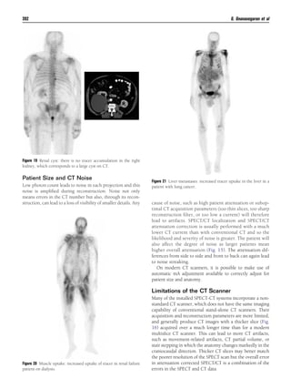 Patient Size and CT Noise
Low photon count leads to noise in each projection and this
noise is ampliﬁed during reconstruction. Noise not only
means errors in the CT number but also, through its recon-
struction, can lead to a loss of visibility of smaller details. Any cause of noise, such as high patient attenuation or subop-
timal CT acquisition parameters (too thin slices, too sharp
reconstruction ﬁlter, or too low a current) will therefore
lead to artifacts. SPECT/CT localization and SPECT/CT
attenuation correction is usually performed with a much
lower CT current than with conventional CT and so the
likelihood and severity of noise is greater. The patient will
also affect the degree of noise as larger patients mean
higher overall attenuation (Fig. 15). The attenuation dif-
ferences from side to side and front to back can again lead
to noise streaking.
On modern CT scanners, it is possible to make use of
automatic mA adjustment available to correctly adjust for
patient size and anatomy.
Limitations of the CT Scanner
Many of the installed SPECT-CT systems incorporate a non-
standard CT scanner, which does not have the same imaging
capability of conventional stand-alone CT scanners. Their
acquisition and reconstruction parameters are more limited,
and generally produce CT images with a thicker slice (Fig.
16) acquired over a much longer time than for a modern
multislice CT scanner. This can lead to more CT artifacts,
such as movement-related artifacts, CT partial volume, or
stair stepping in which the anatomy changes markedly in the
craniocaudal direction. Thicker CT slices may better match
the poorer resolution of the SPECT scan but the overall error
in attenuation corrected SPECT/CT is a combination of the
errors in the SPECT and CT data.
Figure 19 Renal cyst: there is no tracer accumulation in the right
kidney, which corresponds to a large cyst on CT.
Figure 20 Muscle uptake: increased uptake of tracer in renal failure
patient on dialysis.
Figure 21 Liver metastases: increased tracer uptake in the liver in a
patient with lung cancer.
392 G. Gnanasegaran et al
 