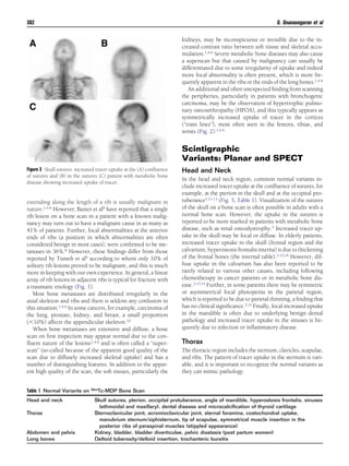 extending along the length of a rib is usually malignant in
nature.1,4-6 However, Baxter et al8 have reported that a single
rib lesion on a bone scan in a patient with a known malig-
nancy may turn out to have a malignant cause in as many as
41% of patients. Further, focal abnormalities at the anterior
ends of ribs (a position in which abnormalities are often
considered benign in most cases), were conﬁrmed to be me-
tastases in 36%.8 However, these ﬁndings differ from those
reported by Tumeh et al9 according to whom only 10% of
solitary rib lesions proved to be malignant, and this is much
more in keeping with our own experience. In general, a linear
array of rib lesions in adjacent ribs is typical for fracture with
a traumatic etiology (Fig. 1).
Most bone metastases are distributed irregularly in the
axial skeleton and ribs and there is seldom any confusion in
this situation.1,4-6 In some cancers, for example, carcinoma of
the lung, prostate, kidney, and breast, a small proportion
(Ͻ10%) affects the appendicular skeleton.10
When bone metastases are extensive and diffuse, a bone
scan on ﬁrst inspection may appear normal due to the con-
ﬂuent nature of the lesions1,4-6 and is often called a “super-
scan” (so-called because of the apparent good quality of the
scan due to diffusely increased skeletal uptake) and has a
number of distinguishing features. In addition to the appar-
ent high quality of the scan, the soft tissues, particularly the
kidneys, may be inconspicuous or invisible due to the in-
creased contrast ratio between soft tissue and skeletal accu-
mulation.1,4-6 Severe metabolic bone diseases may also cause
a superscan but that caused by malignancy can usually be
differentiated due to some irregularity of uptake and indeed
more focal abnormality is often present, which is more fre-
quently apparent in the ribs or the ends of the long bones.1,4-6
An additional and often unexpected ﬁnding from scanning
the peripheries, particularly in patients with bronchogenic
carcinoma, may be the observation of hypertrophic pulmo-
nary osteoarthropathy (HPOA), and this typically appears as
symmetrically increased uptake of tracer in the cortices
(“tram lines”), most often seen in the femora, tibiae, and
wrists (Fig. 2).1,4-6
Scintigraphic
Variants: Planar and SPECT
Head and Neck
In the head and neck region, common normal variants in-
clude increased tracer uptake at the conﬂuence of sutures, for
example, at the pterion in the skull and at the occipital pro-
tuberance3,11-13 (Fig. 3, Table 1). Visualization of the sutures
of the skull on a bone scan is often possible in adults with a
normal bone scan. However, the uptake in the sutures is
reported to be more marked in patients with metabolic bone
disease, such as renal osteodystrophy.3 Increased tracer up-
take in the skull may be focal or diffuse. In elderly patients,
increased tracer uptake in the skull (frontal region and the
calvarium, hyperostosis frontalis interna) is due to thickening
of the frontal bones (the internal table).3,13,14 However, dif-
fuse uptake in the calvarium has also been reported to be
rarely related to various other causes, including following
chemotherapy in cancer patients or in metabolic bone dis-
ease.3,13,14 Further, in some patients there may be symmetric
or asymmetrical focal photopenia in the parietal region,
which is reported to be due to parietal thinning, a ﬁnding that
has no clinical signiﬁcance.3,15 Finally, focal increased uptake
in the mandible is often due to underlying benign dental
pathology and increased tracer uptake in the sinuses is fre-
quently due to infection or inﬂammatory disease.
Thorax
The thoracic region includes the sternum, clavicles, scapulae,
and ribs. The pattern of tracer uptake in the sternum is vari-
able, and it is important to recognize the normal variants as
they can mimic pathology.
Figure 3 Skull sutures: increased tracer uptake at the (A) conﬂuence
of sutures and (B) in the sutures (C) patient with metabolic bone
disease showing increased uptake of tracer.
Table 1 Normal Variants on 99mTc-MDP Bone Scan
Head and neck Skull sutures, pterion, occipital protuberance, angle of mandible, hyperostosis frontalis, sinuses
(ethmoidal and maxillary), dental disease and microcalciﬁcation of thyroid cartilage
Thorax Sternoclavicular joint, acromioclavicular joint, sternal foramina, costochondral uptake,
manubrium sternum/xiphisternum, tip of scapulae, symmetrical muscle insertion in the
posterior ribs of paraspinal muscles (stippled appearance)
Abdomen and pelvis Kidney, bladder, bladder diverticulae, pelvic diastasis (post partum women)
Long bones Deltoid tuberosity/deltoid insertion, trochanteric bursitis
382 G. Gnanasegaran et al
 