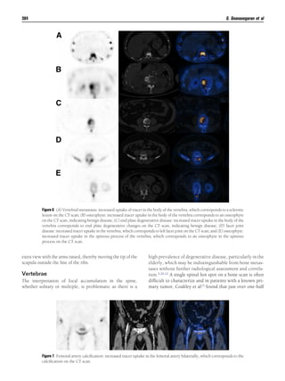 extra view with the arms raised, thereby moving the tip of the
scapula outside the line of the ribs.
Vertebrae
The interpretation of focal accumulation in the spine,
whether solitary or multiple, is problematic as there is a
high prevalence of degenerative disease, particularly in the
elderly, which may be indistinguishable from bone metas-
tases without further radiological assessment and correla-
tion.5,20-22 A single spinal hot spot on a bone scan is often
difﬁcult to characterize and in patients with a known pri-
mary tumor, Coakley et al23 found that just over one-half
Figure 6 (A) Vertebral metastasis: increased uptake of tracer in the body of the vertebra, which corresponds to a sclerotic
lesion on the CT scan; (B) osteophyte: increased tracer uptake in the body of the vertebra corresponds to an osteophyte
on the CT scan, indicating benign disease; (C) end plate degenerative disease: increased tracer uptake in the body of the
vertebra corresponds to end plate degenerative changes on the CT scan, indicating benign disease; (D) facet joint
disease: increased tracer uptake in the vertebra, which corresponds to left facet joint on the CT scan; and (E) osteophyte:
increased tracer uptake in the spinous process of the vertebra, which corresponds to an osteophyte in the spinous
process on the CT scan.
Figure 7 Femoral artery calciﬁcation: increased tracer uptake in the femoral artery bilaterally, which corresponds to the
calciﬁcation on the CT scan.
384 G. Gnanasegaran et al
 