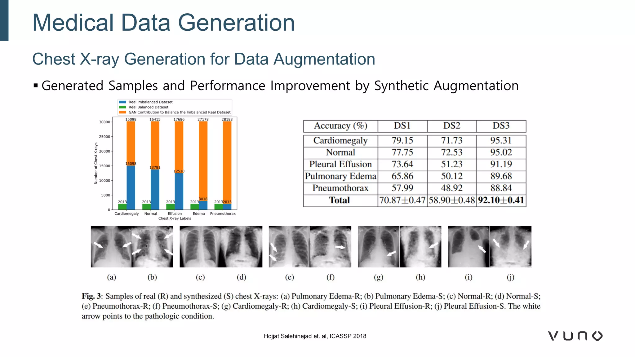 ▪ Generated Samples and Performance Improvement by Synthetic Augmentation
Chest X-ray Generation for Data Augmentation
Medical Data Generation
Hojjat Salehinejad et. al, ICASSP 2018
 