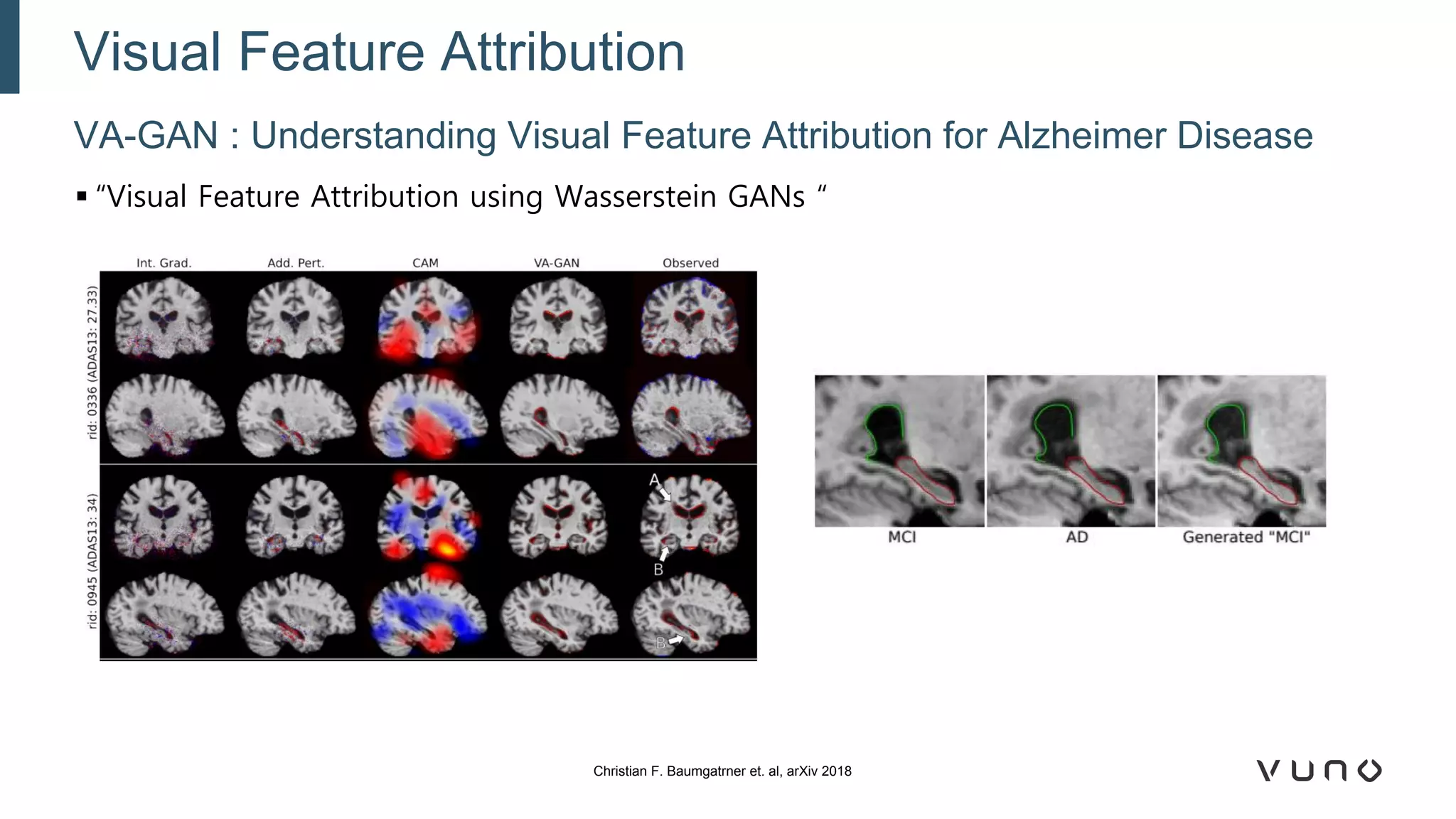 ▪ “Visual Feature Attribution using Wasserstein GANs “
VA-GAN : Understanding Visual Feature Attribution for Alzheimer Disease
Visual Feature Attribution
Christian F. Baumgatrner et. al, arXiv 2018
 