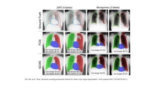 JSRT (4 labels) Montgomery (3 labels)
Dai, Wei, et al. "Scan: Structure correcting adversarial network for chest x-rays organ segmentation." arXiv preprint arXiv:1703.08770 (2017).
 