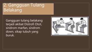 2. Gangguan Tulang
Belakang
Gangguan tulang belakang
terjadi akibat Distrofi Otot,
sindrom marfan, sindrom
down, sikap tubuh yang
buruk.
 