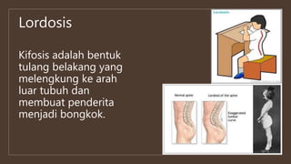 Kifosis adalah bentuk
tulang belakang yang
melengkung ke arah
luar tubuh dan
membuat penderita
menjadi bongkok.
Lordosis
 