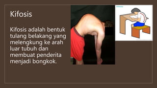 Kifosis
Kifosis adalah bentuk
tulang belakang yang
melengkung ke arah
luar tubuh dan
membuat penderita
menjadi bongkok.
 