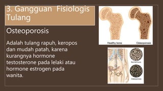 Osteoporosis
3. Gangguan Fisiologis
Tulang
Adalah tulang rapuh, keropos
dan mudah patah, karena
kurangnya hormone
testosterone pada lelaki atau
hormone estrogen pada
wanita.
 