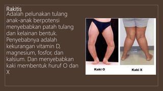 Rakitis
Adalah pelunakan tulang
anak-anak berpotensi
menyebabkan patah tulang
dan kelainan bentuk.
Penyebabnya adalah
kekurangan vitamin D,
magnesium, fosfor, dan
kalsium. Dan menyebabkan
kaki membentuk huruf O dan
X
 