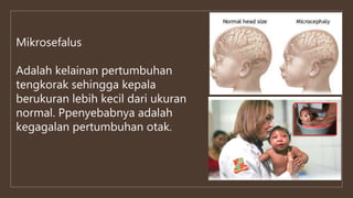 Mikrosefalus
Adalah kelainan pertumbuhan
tengkorak sehingga kepala
berukuran lebih kecil dari ukuran
normal. Ppenyebabnya adalah
kegagalan pertumbuhan otak.
 