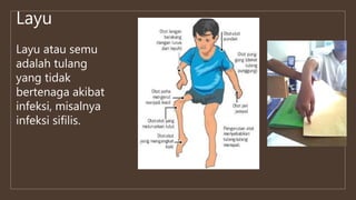 Layu
Layu atau semu
adalah tulang
yang tidak
bertenaga akibat
infeksi, misalnya
infeksi sifilis.
 