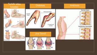 Terkilir atau
keseleo
Dislokasi Ankilosis
Urai Sendi
 
