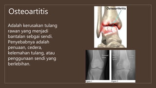 Osteoartitis
Adalah kerusakan tulang
rawan yang menjadi
bantalan sebgai sendi.
Penyebabnya adalah
penuaan, cedera,
kelemahan tulang, atau
penggunaan sendi yang
berlebihan.
 