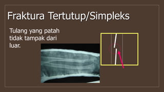 Fraktura Tertutup/Simpleks
Tulang yang patah
tidak tampak dari
luar.
 