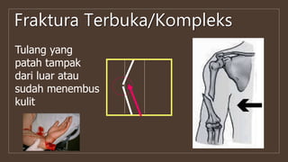 Fraktura Terbuka/Kompleks
Tulang yang
patah tampak
dari luar atau
sudah menembus
kulit
 