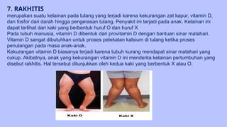 Kaki Rakhitis Gangguan Pada Tulang errererrrwrwrr.pptx