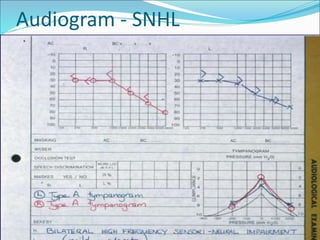 Audiogram - SNHL
 