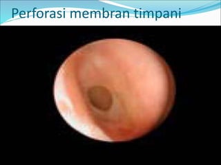 Perforasi membran timpani
 
