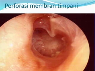 Perforasi membran timpani
 