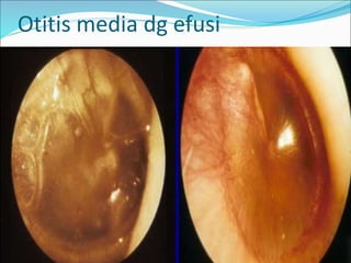Otitis media dg efusi
 