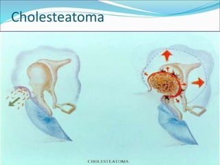 Cholesteatoma
 