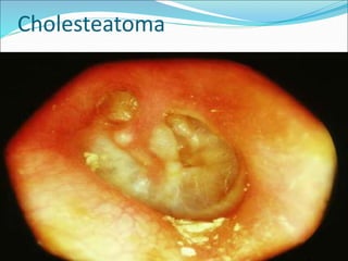 Cholesteatoma
 