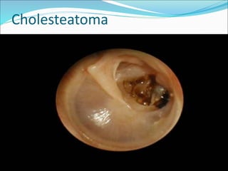Cholesteatoma
 