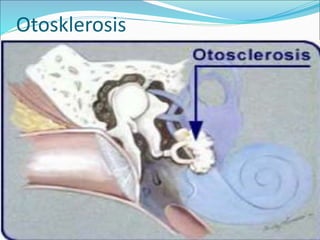 Otosklerosis
 