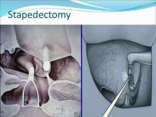 Stapedectomy
 