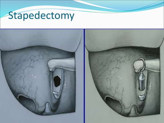 Stapedectomy
 