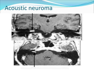 Acoustic neuroma
 