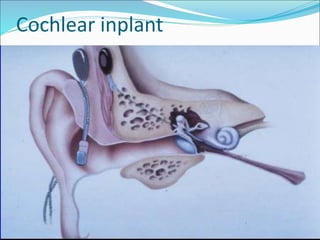 Cochlear inplant
 