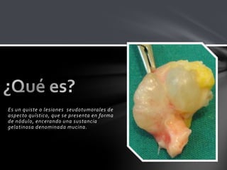 Es un quiste o lesiones seudotumorales de
aspecto quístico, que se presenta en forma
de nódulo, encerando una sustancia
gelatinosa denominada mucina.
 