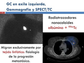 GC en axila izquierda,
Gammagrafía y SPECT/TC
Radiotrazadores
nanocoloides
albúmina + 99mTc
Migran exclusivamente por
tejido linfático: fisiología
de la progresión
metastásica.
7
 