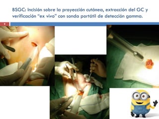 BSGC: Incisión sobre la proyección cutánea, extracción del GC y
verificación “ex vivo” con sonda portátil de detección gamma.
9
 