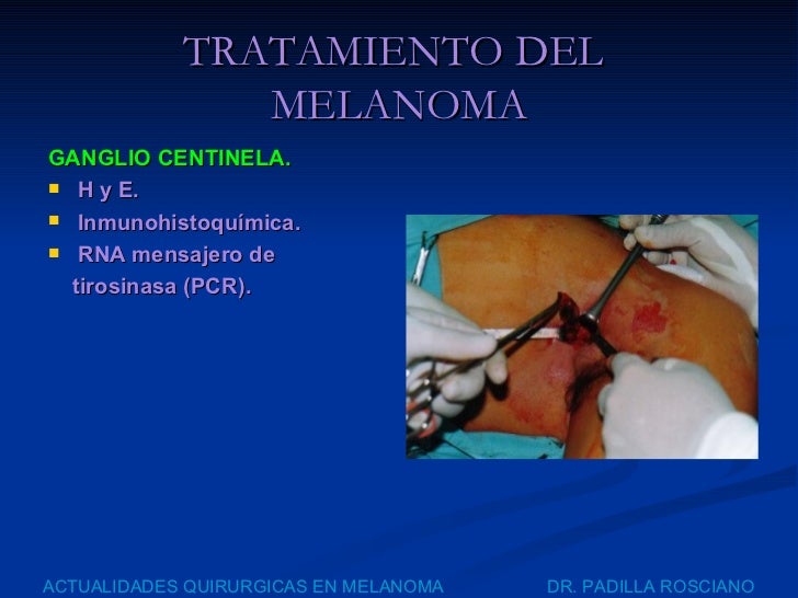 Ganglio centinela en melanoma
