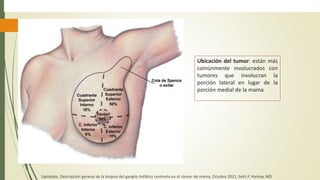 Ubicación del tumor: están más
comúnmente involucrados con
tumores que involucran la
porción lateral en lugar de la
porción medial de la mama
Uptodate, Descripción general de la biopsia del ganglio linfático centinela en el cáncer de mama, Octubre 2021, Seth P. Harlow, MD
 