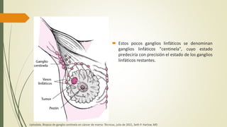  Estos pocos ganglios linfáticos se denominan
ganglios linfáticos "centinela", cuyo estado
predeciría con precisión el estado de los ganglios
linfáticos restantes.
Uptodate, Biopsia de ganglio centinela en cáncer de mama: Técnicas, julio de 2021, Seth P. Harlow, MD
 