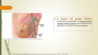  La biopsia del ganglio linfático
centinela ha reemplazado a la disección de los
ganglios linfáticos axilares en la mayoría de los
pacientes con cáncer de mama temprano
Uptodate, Biopsia de ganglio centinela en cáncer de mama: Técnicas, julio de 2021, Seth P. Harlow, MD
 