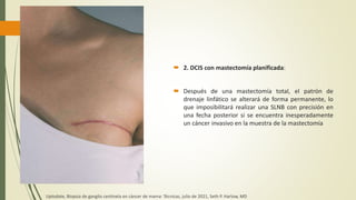  2. DCIS con mastectomía planificada:
 Después de una mastectomía total, el patrón de
drenaje linfático se alterará de forma permanente, lo
que imposibilitará realizar una SLNB con precisión en
una fecha posterior si se encuentra inesperadamente
un cáncer invasivo en la muestra de la mastectomía
Uptodate, Biopsia de ganglio centinela en cáncer de mama: Técnicas, julio de 2021, Seth P. Harlow, MD
 