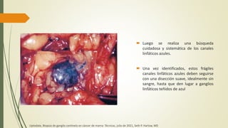  Luego se realiza una búsqueda
cuidadosa y sistemática de los canales
linfáticos azules.
 Una vez identificados, estos frágiles
canales linfáticos azules deben seguirse
con una disección suave, idealmente sin
sangre, hasta que den lugar a ganglios
linfáticos teñidos de azul
Uptodate, Biopsia de ganglio centinela en cáncer de mama: Técnicas, julio de 2021, Seth P. Harlow, MD
 
