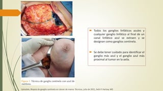  Todos los ganglios linfáticos azules y
cualquier ganglio linfático al final de un
canal linfático azul se extraen y se
designan como ganglios centinela.
 Se debe tener cuidado para identificar el
ganglio más azul y el ganglio azul más
proximal al tumor en la axila.
Uptodate, Biopsia de ganglio centinela en cáncer de mama: Técnicas, julio de 2021, Seth P. Harlow, MD
 