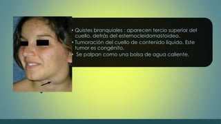 • Quistes branquiales : aparecen tercio superior del 
cuello, detrás del esternocleidomastoideo. 
• Tumoración del cuello de contenido líquido. Este 
tumor es congénito. 
• Se palpan como una bolsa de agua caliente. 
 