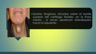 •Quistes tiroglosos :situados sobre el borde 
superior del cartilago tiroides, en la línea 
media , a veces aparecen lateralizados 
hacia la izquierda 
