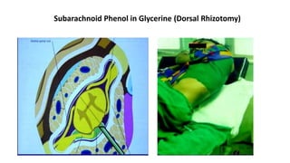 Subarachnoid Phenol in Glycerine (Dorsal Rhizotomy)
 