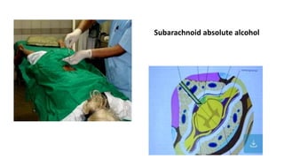 Subarachnoid absolute alcohol
 